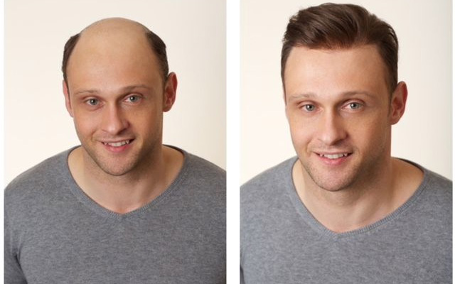 Male hair wig result for baldness coverage