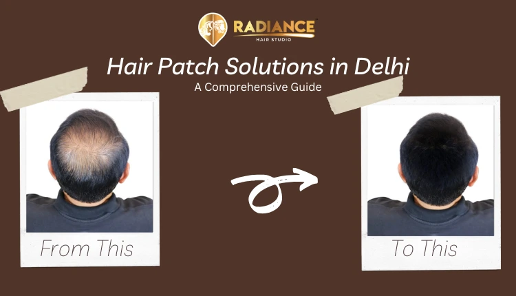 hair patch solutions in Delhi
