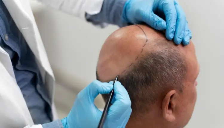 non surgical hair replacement in delhi