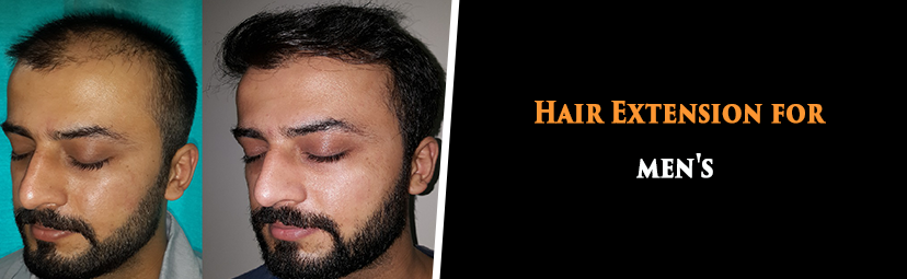 Hair Extensions for men in Delhi - Radiance Hair Studio
